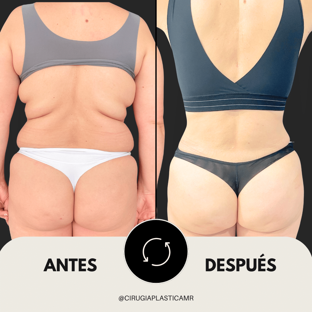 abdominoplastia_lipotransferencia_cirugia_medellin
