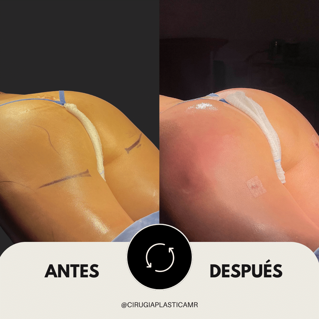 liposuccion_lipotransferencia_gluteos_cirugia_medellin_colombia