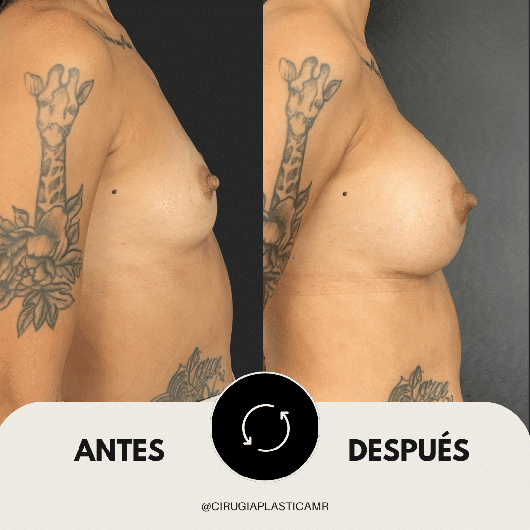 mamoplastia_cirugia_medellin_colombia