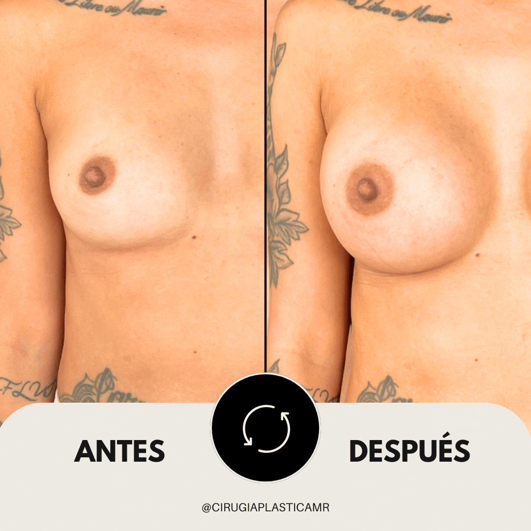 mamoplastia_cirugia_segura_medellin