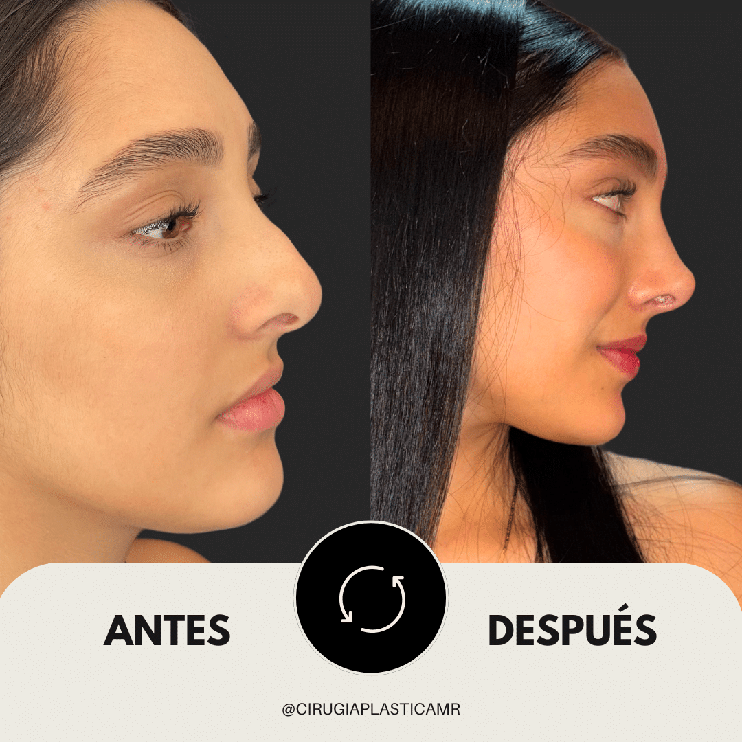 rinoplastia_antes_depues_medellin_cirugia_medellin