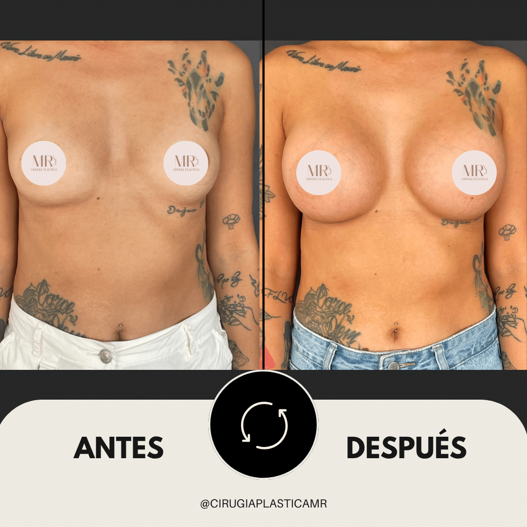 mamoplastia_aumento_senos_medellin_cirugia_cirujanos_best_surgeon