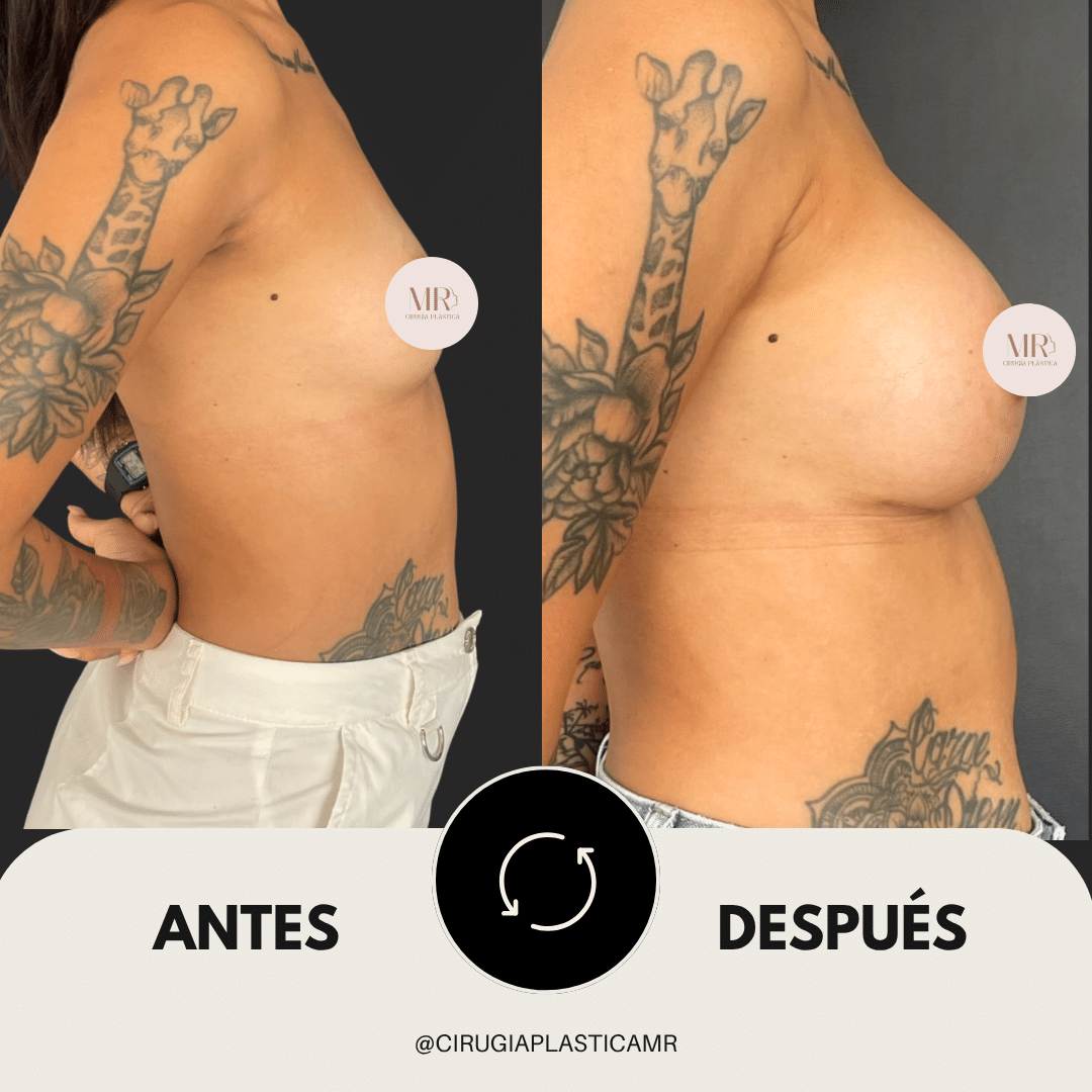 mamoplastia_aumento_senos_medellin_cirugia_cirujanos_surgeon